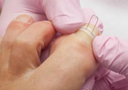 Ingegroeide nagel Tilburg